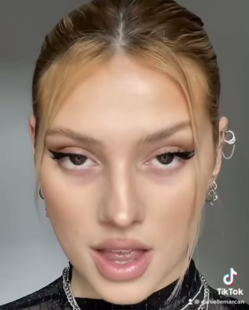 синяки под глазами