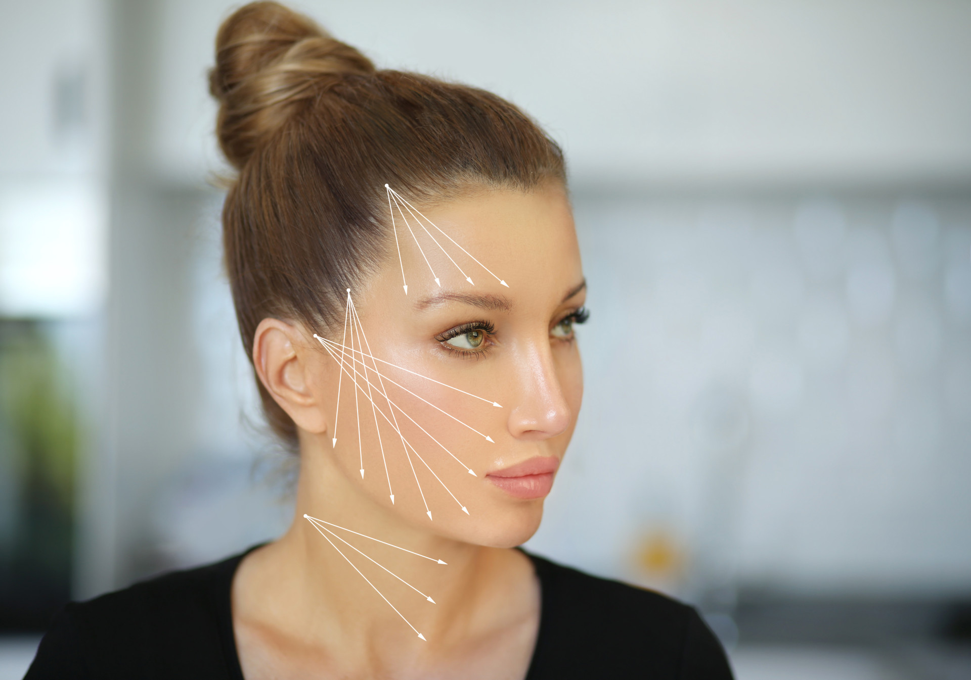 нитевой лифтинг