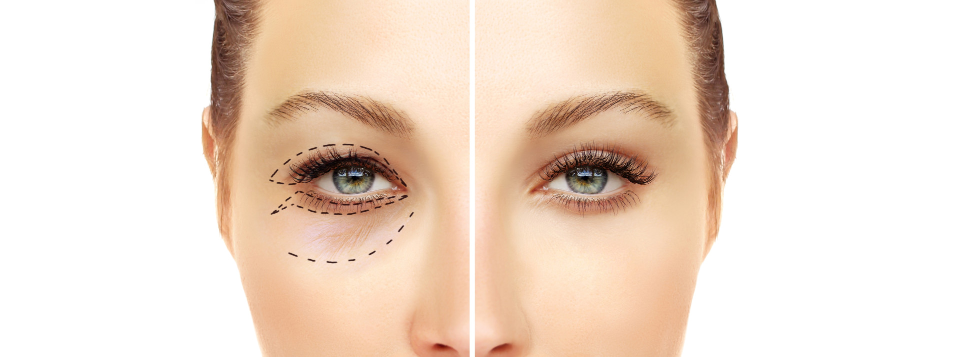 Плюсы и минусы безоперационной блефаропластики Плюсы и минусы безоперационной блефаропластики