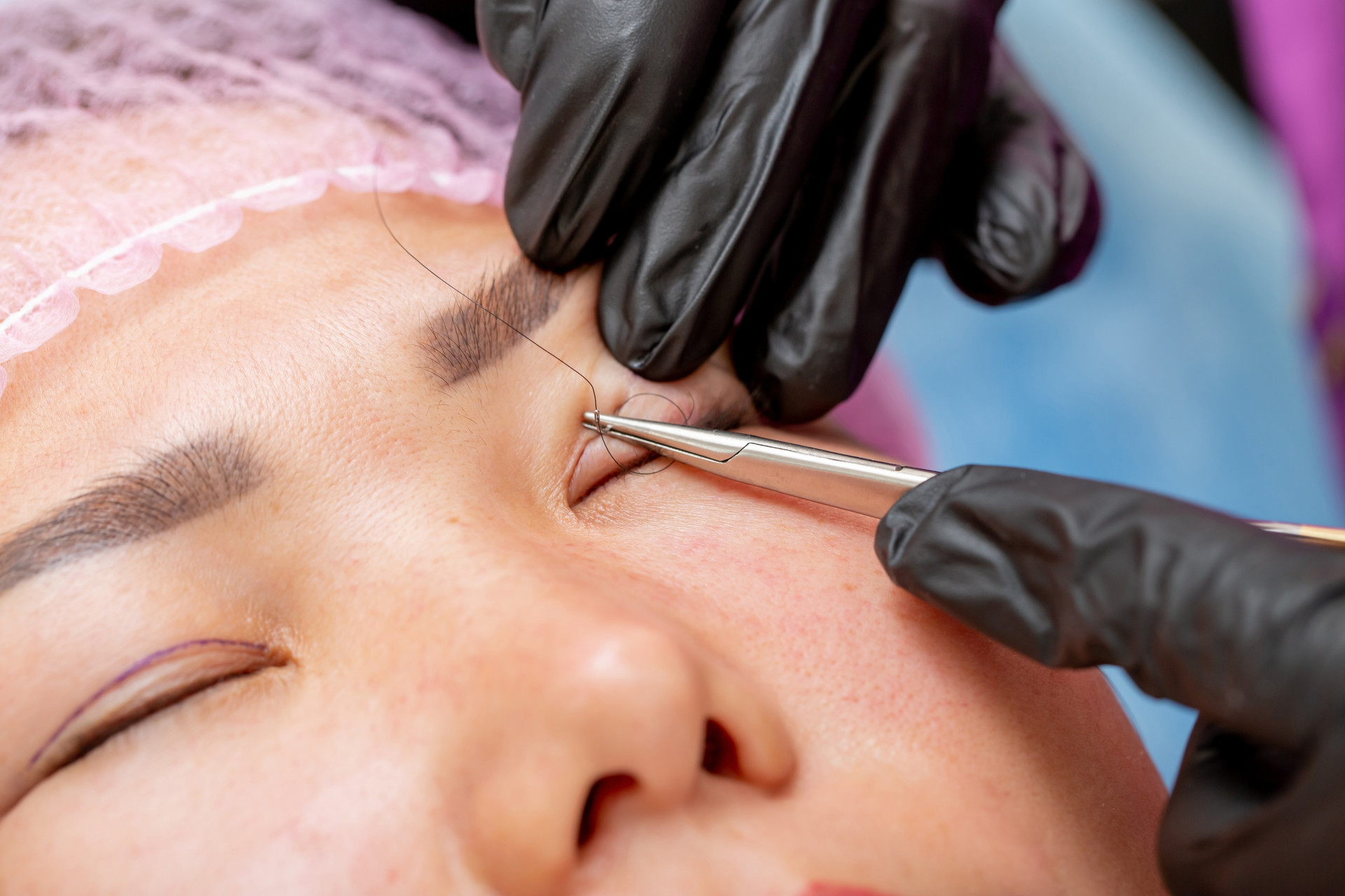 Нитевая блефаропластика Нитевая блефаропластика