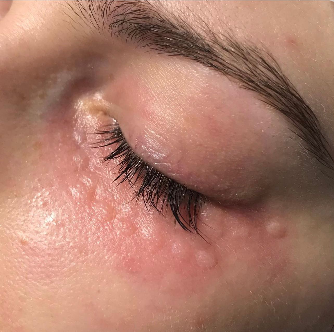 Мезотерапия Мезотерапия