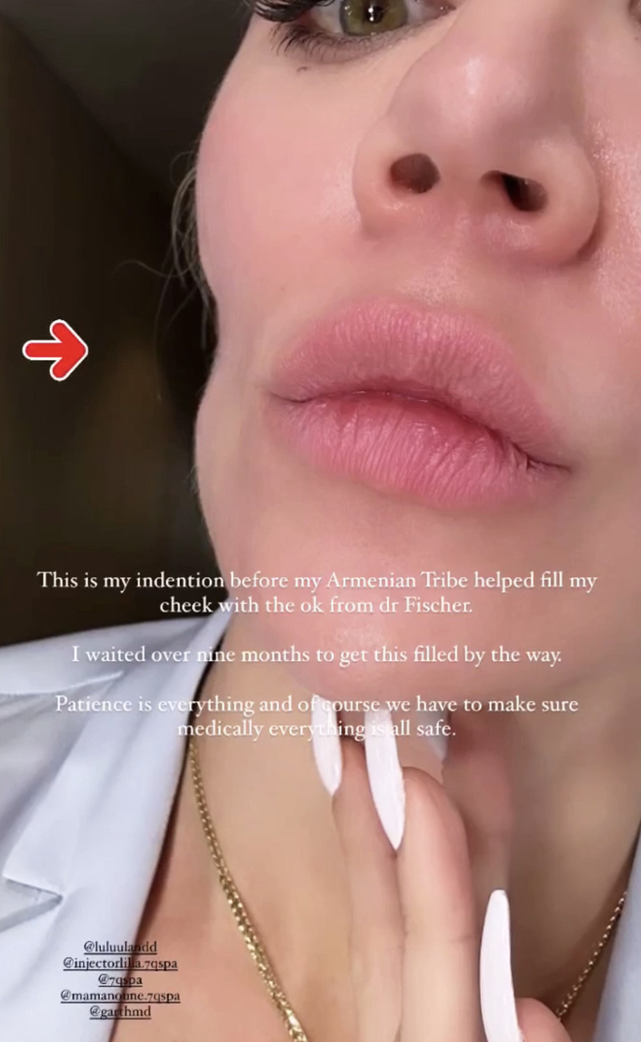 Хлои Кардашьян филлеры